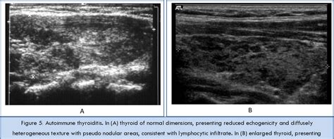 Hashimotos Thyroiditis Ultrasound