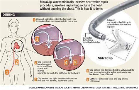 New Procedure to Help Heart Patients | Heart patient, Heart valves ...