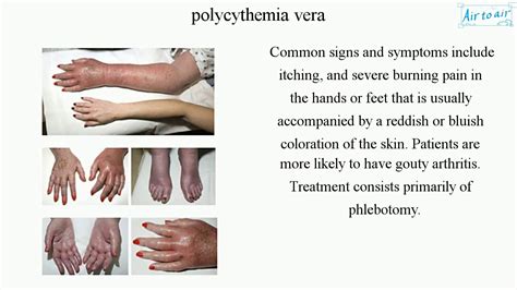 polycythemia vera - YouTube