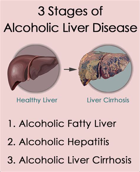 Alcoholic Liver Disease Symptoms, Stages, Treatment - Summit Rehab