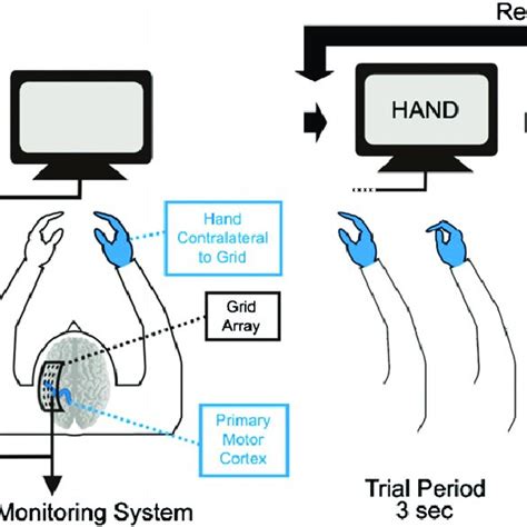 ECoG placement and localization. Intraoperative photograph illustrating... | Download Scientific ...