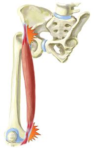 Sartorius Muscle Pain