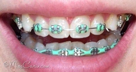 mint green braces: bottom power chain | Green braces, Cute braces, Cute braces colors