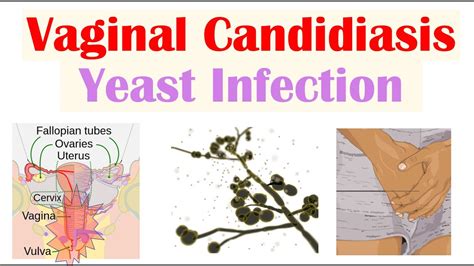 Vaginal Candidiasis (“Yeast Infection”) Causes, Risk Factors, Signs & Symptoms, Diagnosis ...