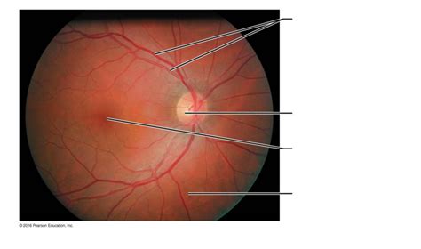 Part of the Posterior Wall (Fundus) of the Right Eye as Seen with an ...