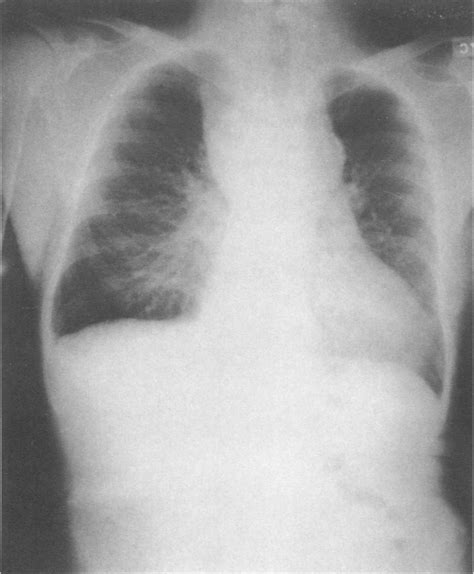 Chest radiograph on 2nd admission, showing a right paratracheal mass ...