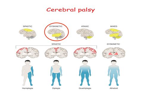 Athetoid Cerebral Palsy