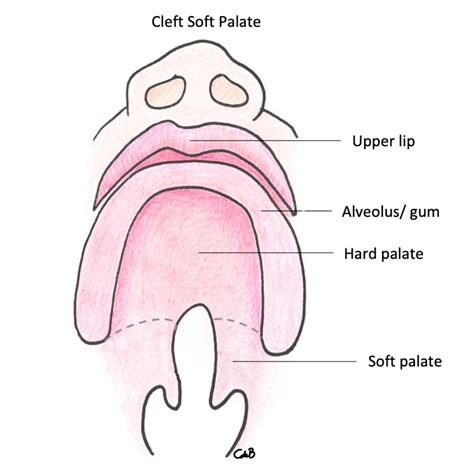 Different types of cleft explained . Cleft Lip & Palate Explained . Cleft Care Ireland