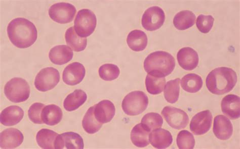 Macrocytosis: What You Need to Know