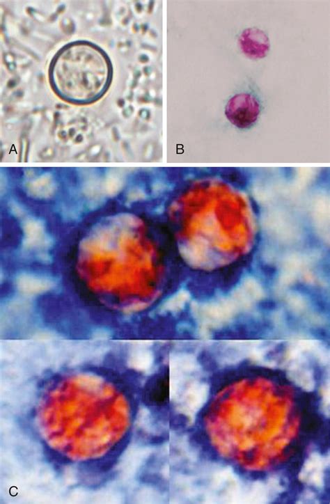 Cyclospora cayetanensis, Cystoisospora belli, Sarcocystis Species, Balantidium coli, and ...