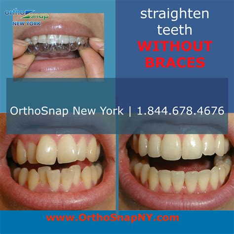 Pin by OrthoSnap New York on Clear Braces | Teeth straightening ...
