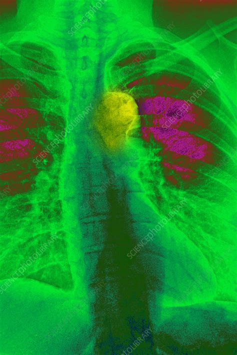 Atheromatous aorta, x-ray - Stock Image - C026/8788 - Science Photo Library