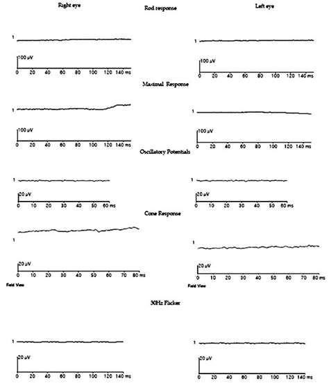 Electroretinogram of the patient. | Download Scientific Diagram