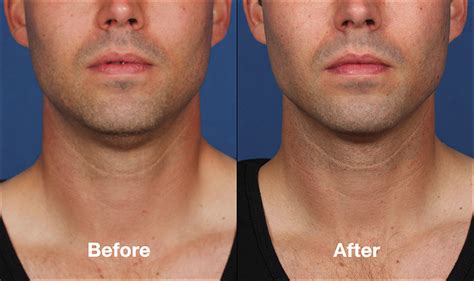 St Louis Kybella | Double Chin Treatment | St Louis Lipo Center