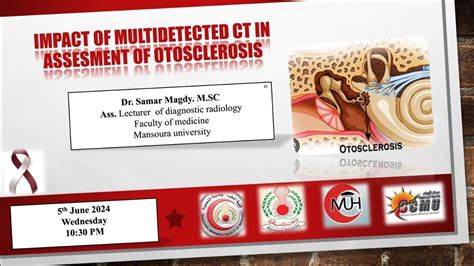 Impact of Multi-Detector CT scan inassessment of otosclerosis by Dr ...