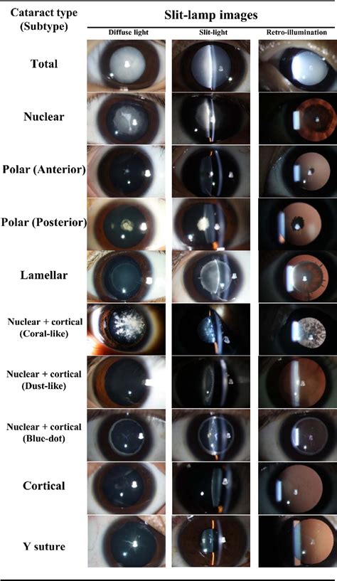 Figure 3 from Monitoring and Morphologic Classification of Pediatric Cataract Using Slit-Lamp ...