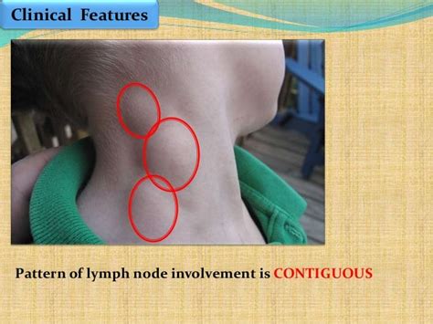 Hodgkin's lymphoma early stage management