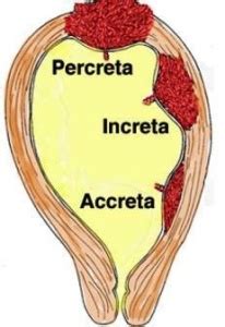 Placenta Accreta - What is, Symptoms, Risk Factors, Diagnosis