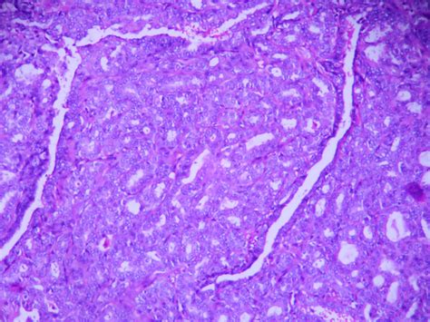 Tubular adenoma – Histopathology.guru