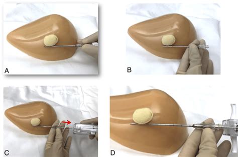 Feasibility Thermal call core needle aspiration complement Supervise catch a cold