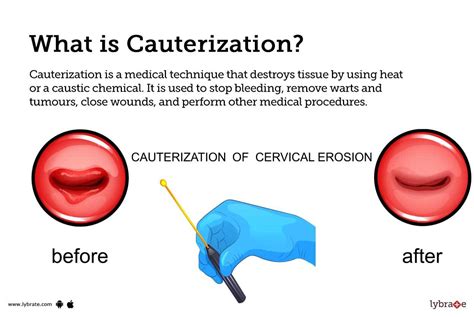 Cauterization To Stop Bleeding