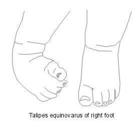 54 best images about Talipes on Pinterest | Physical therapy, Increase flexibility and Methods