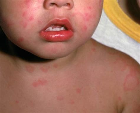 Urticaria - Causes, Symptoms, Treatment, Home Remedies