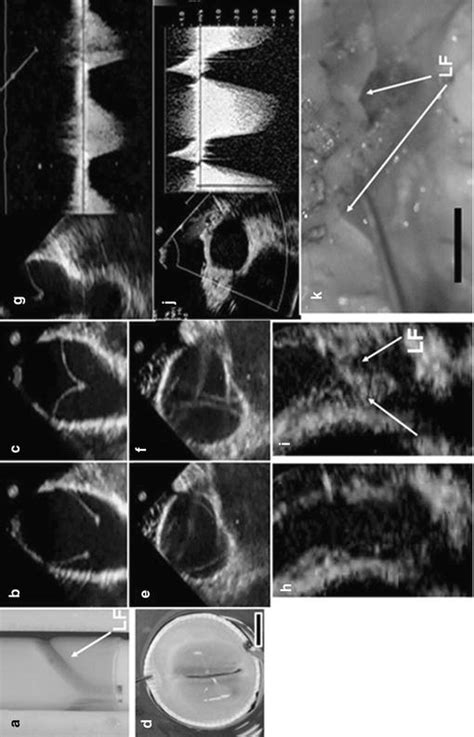 Tissue-Engineered Heart Valves | Thoracic Key