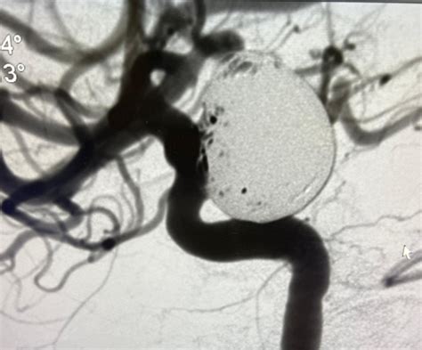 Giant Ruptured ICA Aneurysm Treatment