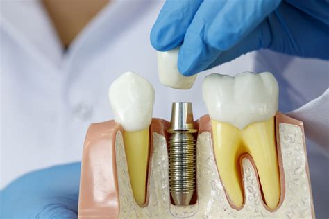 What You Need to Know About Dental Implants - Fairfield Dental Arts