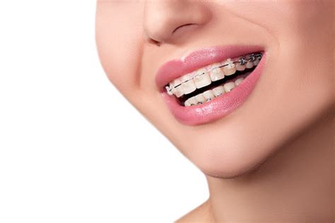 Lingual Braces | Tingey Orthodontics