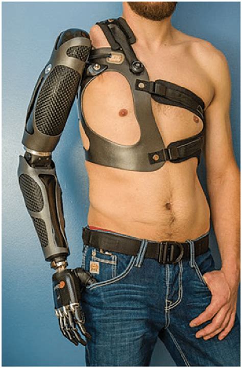 Myoelectric Prosthesis, Complex Hand, #Arm Dynamics. Photo permission... | Download Scientific ...