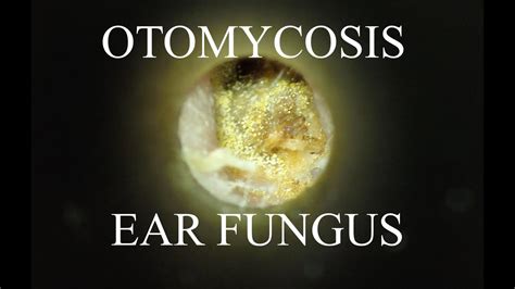 EAR FUNGUS : OTOMYCOSIS : 4K/HD - YouTube