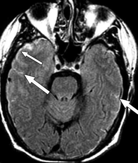 Hyperintensity in the Subarachnoid Space on FLAIR MRI | AJR