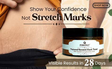 POKONUT Ayurvedic Stretch Mark Cream | Improves appearance of Fresh and ...