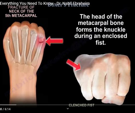 boxers fracture | Sherdog Forums | UFC, MMA & Boxing Discussion