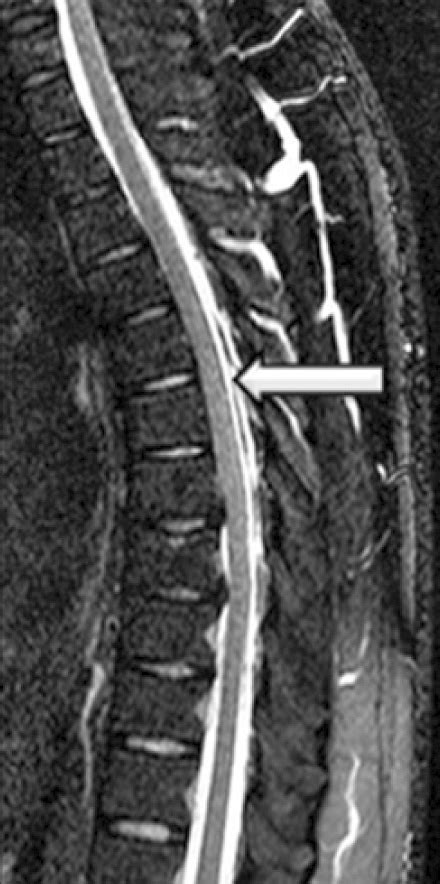 Epidural cerebrospinal fluid collection. Arrows show (A) epidural fluid... | Download Scientific ...