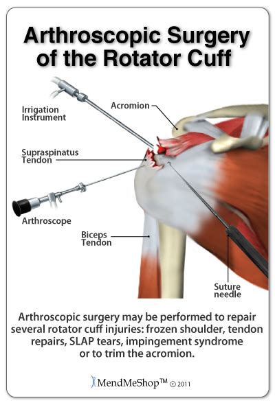 Shoulder Post Surgery Rehabilitation