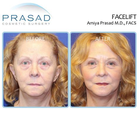 How to Speed Up Facelift Recovery | Dr. Amiya Prasad Blog | New York