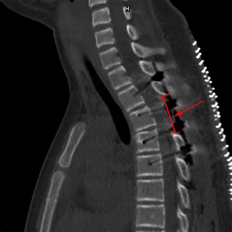 Computed tomography sagittal image after the surgery revealing a red... | Download Scientific ...