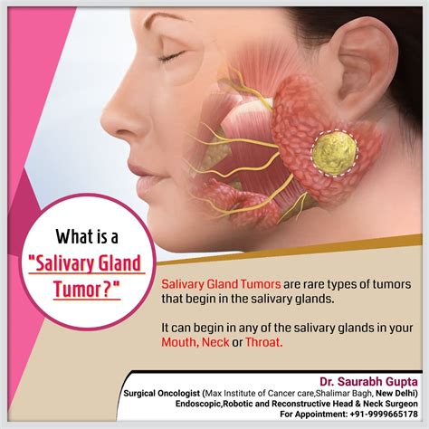 Pin on Salivary Gland Tumor