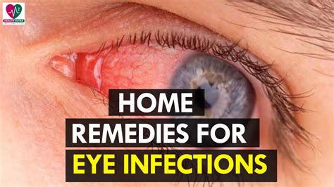 Home Remedies for Eye Infections - Health Sutra - YouTube