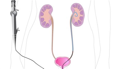 Ureteroscopy Procedure Explained With Post Surgical Risks - YouTube