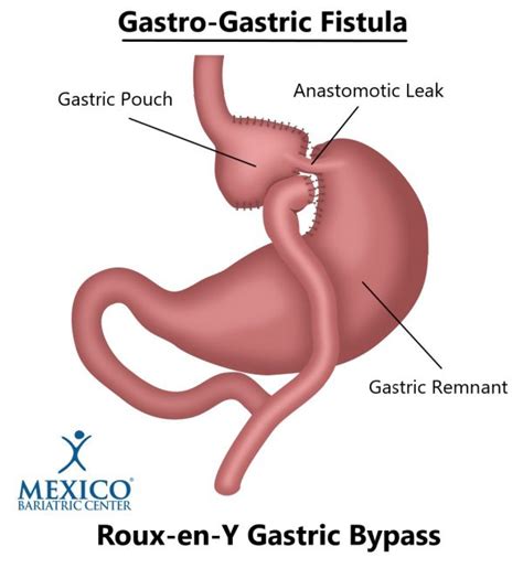 Signs and Symptoms of Ulcers After Gastric Bypass - Mexico Bariatric Center