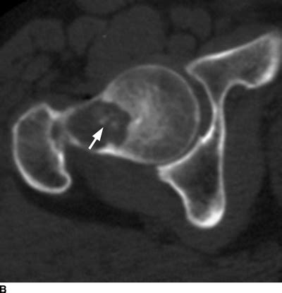 Benign Lesions | Radiology Key