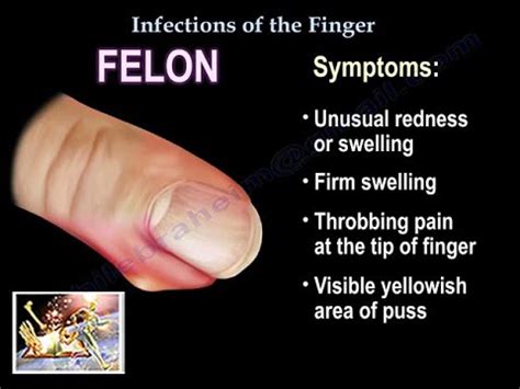 How Do I Know If I Have A Felony Infection