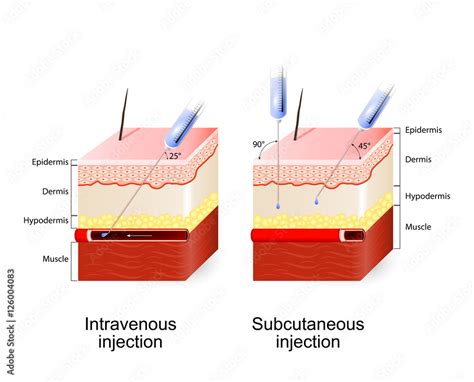 Intravenous therapy and Subcutaneous injection. Stock Vector | Adobe Stock