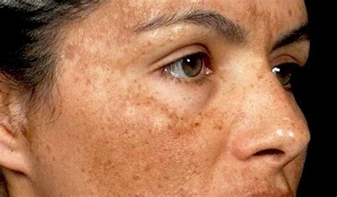 5 Tricks To Get Rid Of Dark Spots And Hyperpigmentation by Sarah Healy - Musely