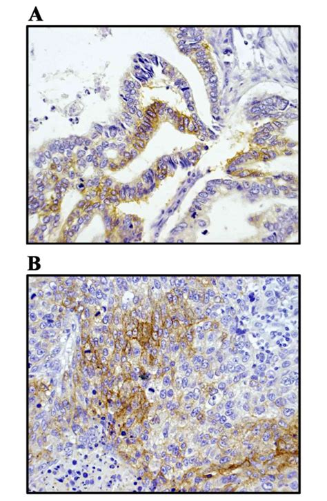 CD117 expression is a predictive marker for poor prognosis in patients ...