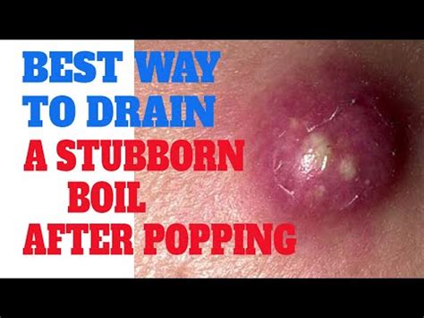 How to draining a boil | How to draining abscess boil | Drainage of abscess cyst - YouTube